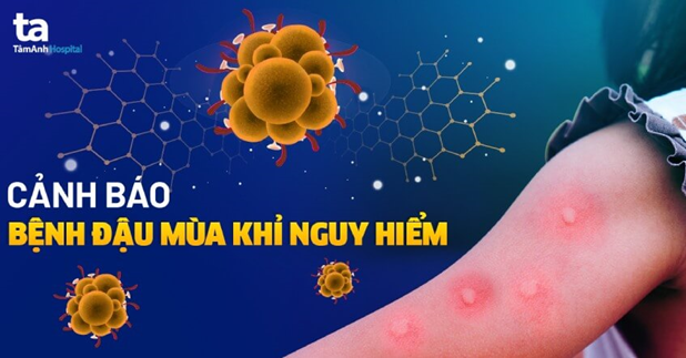 Bệnh đậu mùa khỉ: nguyên nhân, triệu chứng, điều trị và phòng ngừa