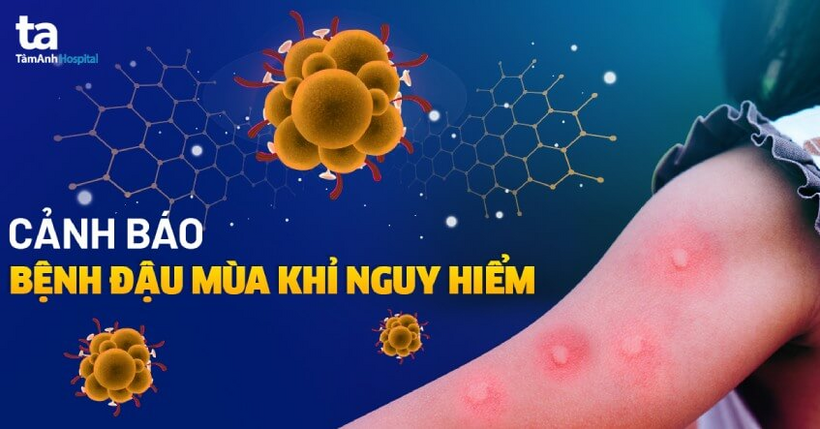 benh dau mua khi la gi