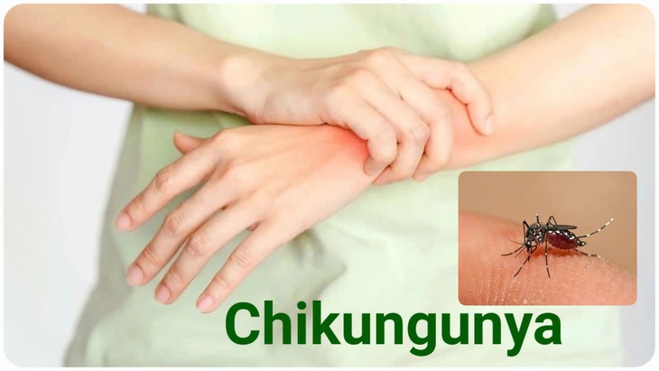 Chikungunya - Ảnh 1.