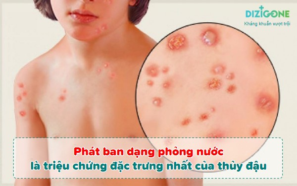 Bệnh Thuỷ Đậu : Nguyên nhân, Triệu chứng, biến chứng và cách điều trị.